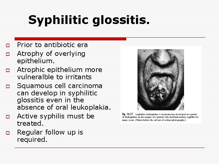 Syphilitic glossitis. o o o Prior to antibiotic era Atrophy of overlying epithelium. Atrophic