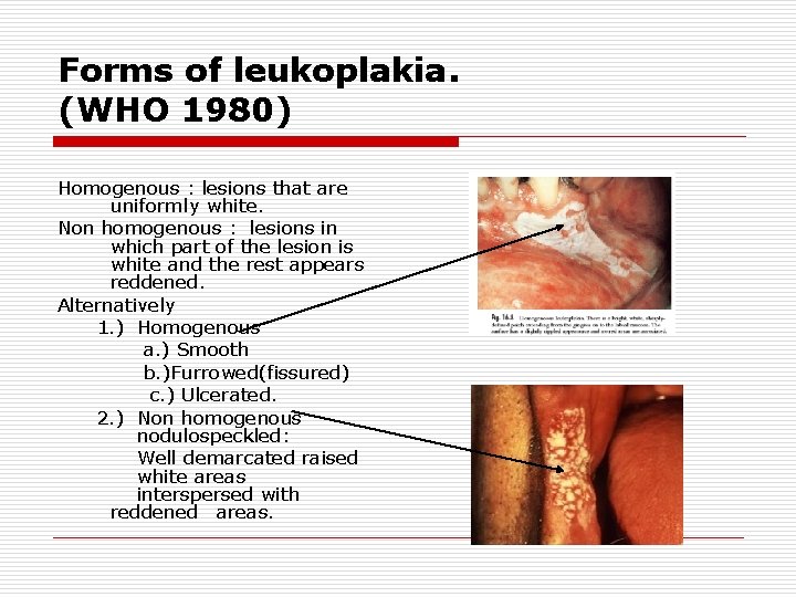 Forms of leukoplakia. (WHO 1980) Homogenous : lesions that are uniformly white. Non homogenous