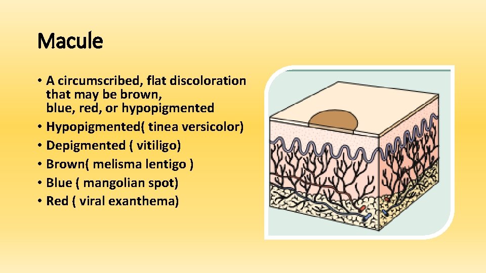 Macule • A circumscribed, flat discoloration that may be brown, blue, red, or hypopigmented
