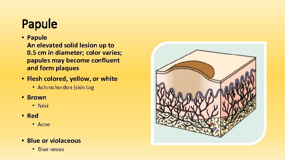 Papule • Papule An elevated solid lesion up to 0. 5 cm in diameter;