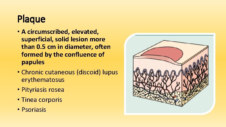 Plaque • A circumscribed, elevated, superficial, solid lesion more than 0. 5 cm in