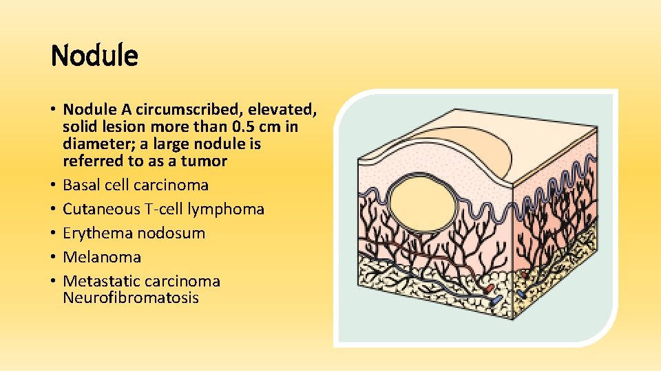 Nodule • Nodule A circumscribed, elevated, solid lesion more than 0. 5 cm in