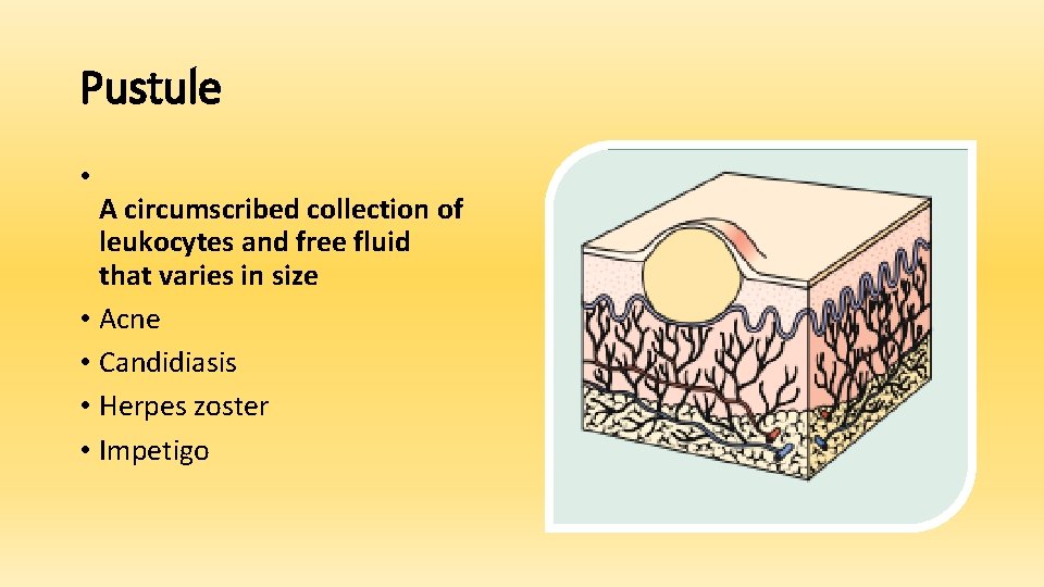 Pustule • A circumscribed collection of leukocytes and free fluid that varies in size
