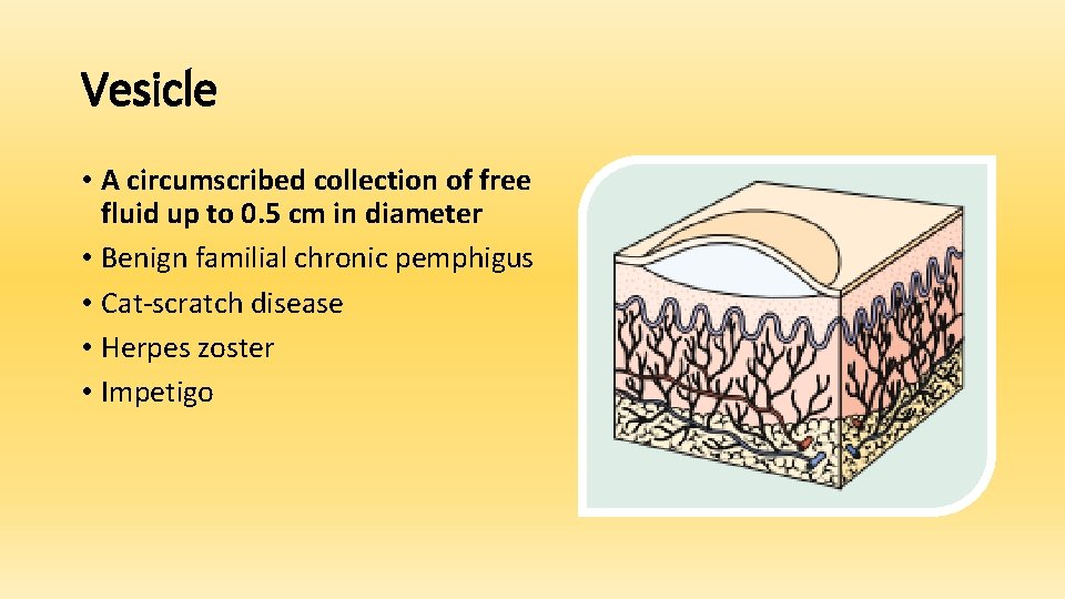 Vesicle • A circumscribed collection of free fluid up to 0. 5 cm in
