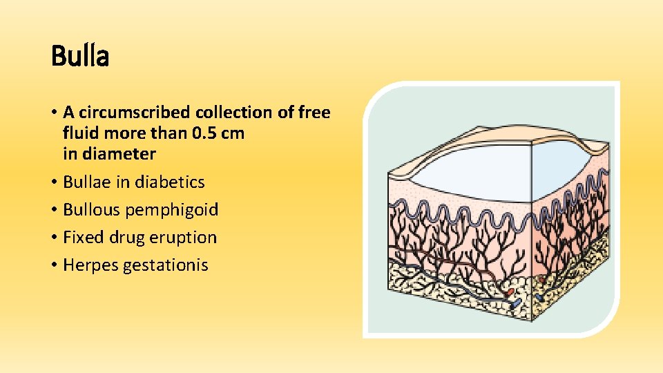 Bulla • A circumscribed collection of free fluid more than 0. 5 cm in