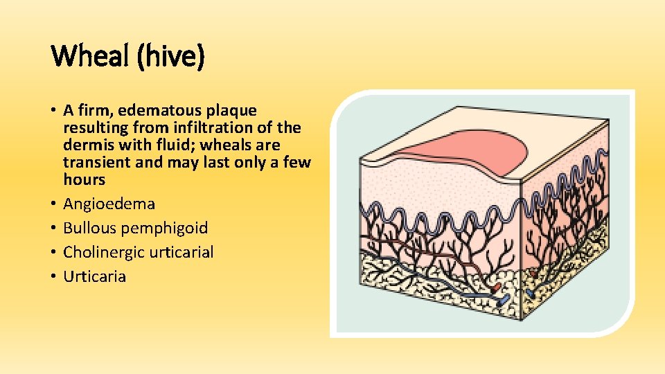 Wheal (hive) • A firm, edematous plaque resulting from infiltration of the dermis with