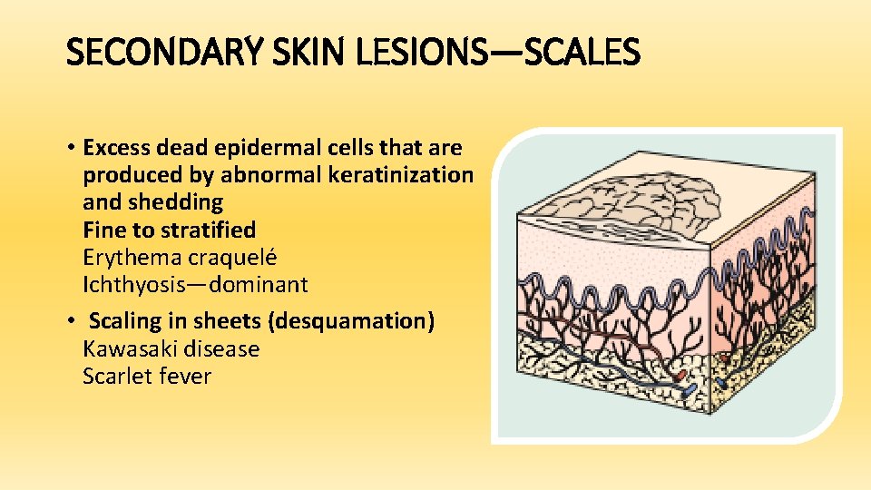 SECONDARY SKIN LESIONS—SCALES • Excess dead epidermal cells that are produced by abnormal keratinization