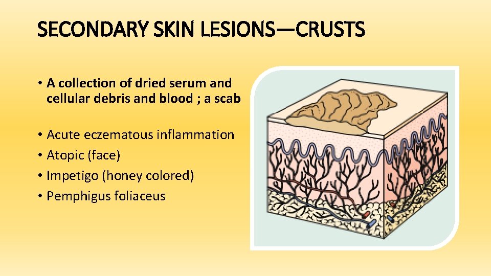 SECONDARY SKIN LESIONS—CRUSTS • A collection of dried serum and cellular debris and blood
