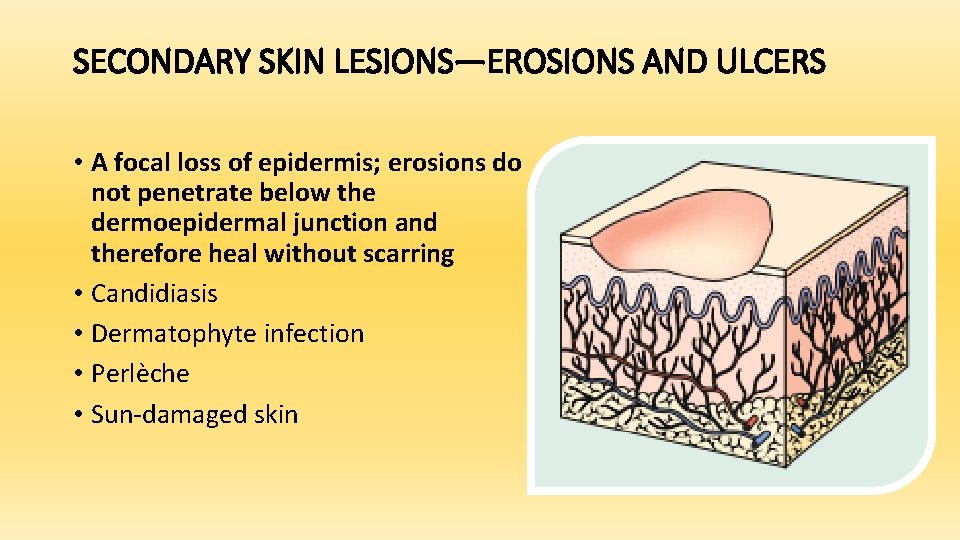 SECONDARY SKIN LESIONS—EROSIONS AND ULCERS • A focal loss of epidermis; erosions do not