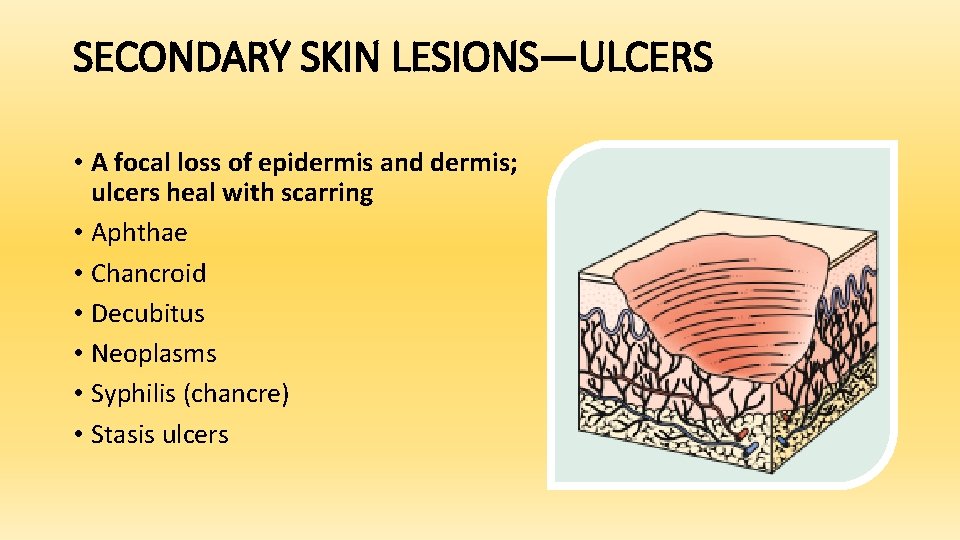 SECONDARY SKIN LESIONS—ULCERS • A focal loss of epidermis and dermis; ulcers heal with