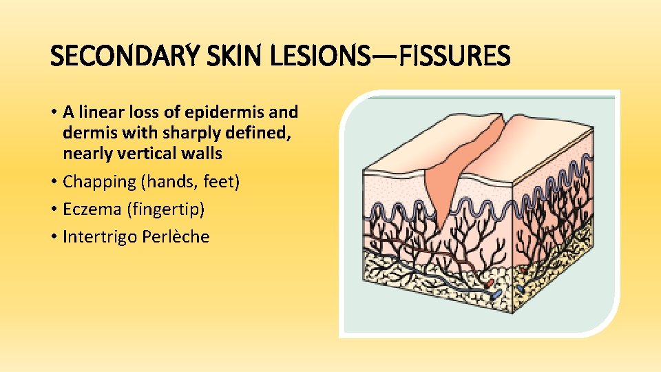SECONDARY SKIN LESIONS—FISSURES • A linear loss of epidermis and dermis with sharply defined,