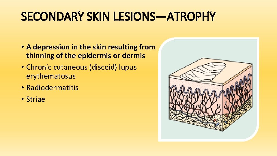 SECONDARY SKIN LESIONS—ATROPHY • A depression in the skin resulting from thinning of the
