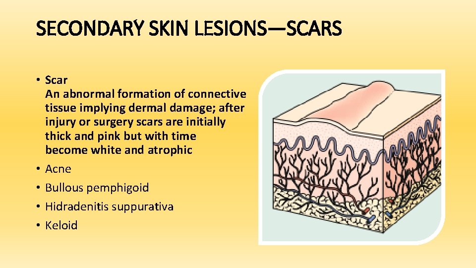SECONDARY SKIN LESIONS—SCARS • Scar An abnormal formation of connective tissue implying dermal damage;