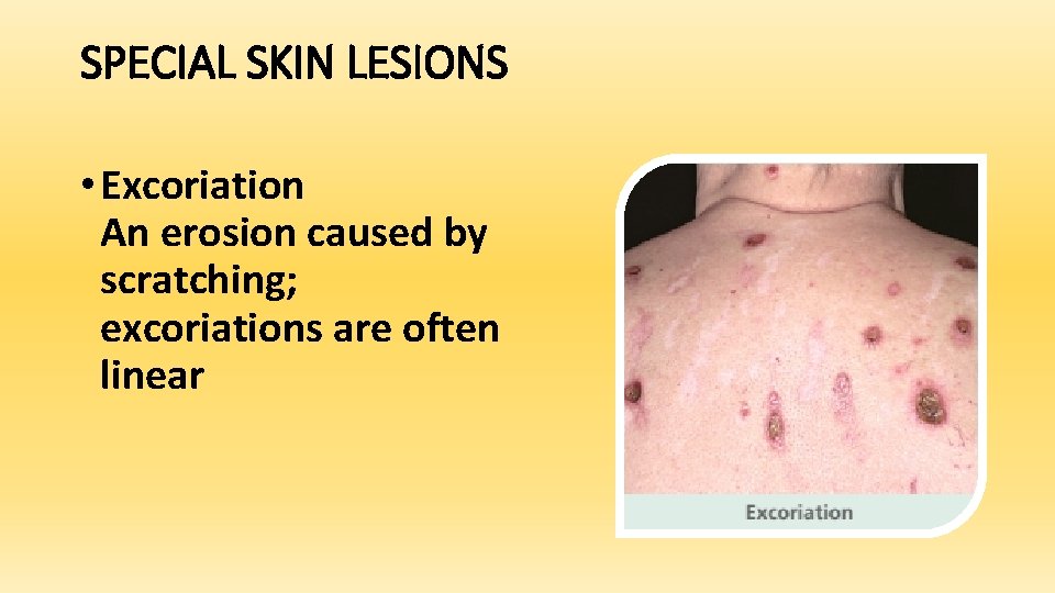 SPECIAL SKIN LESIONS • Excoriation An erosion caused by scratching; excoriations are often linear
