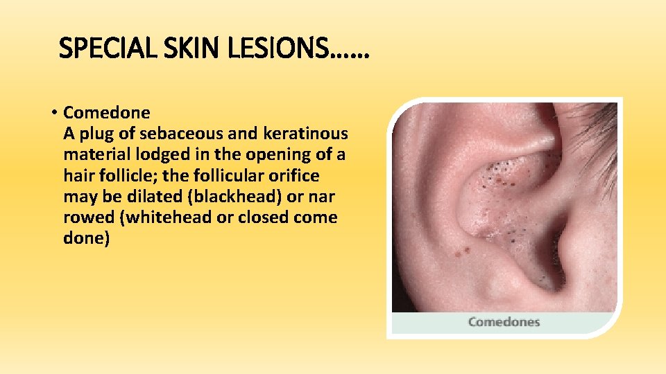 SPECIAL SKIN LESIONS…… • Comedone A plug of sebaceous and keratinous material lodged in