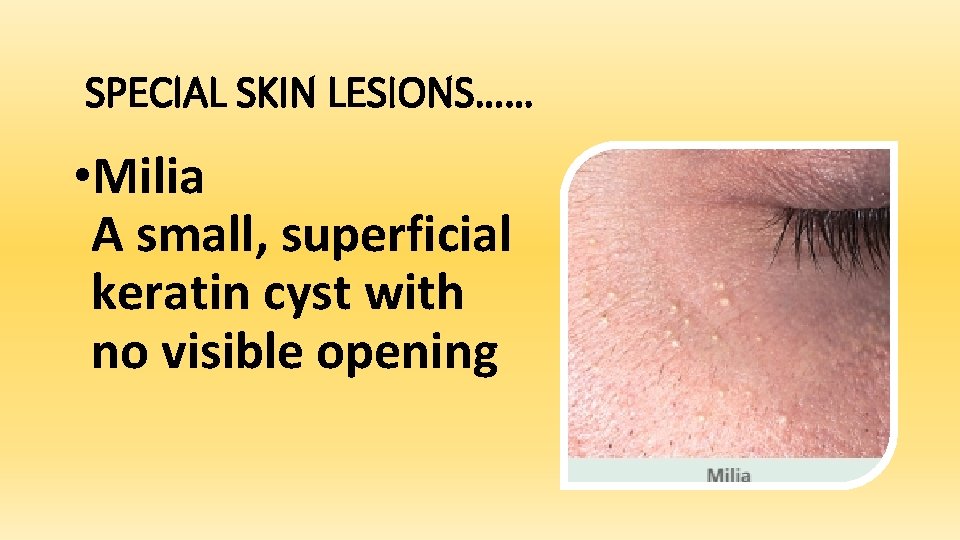 SPECIAL SKIN LESIONS…… • Milia A small, superficial keratin cyst with no visible opening