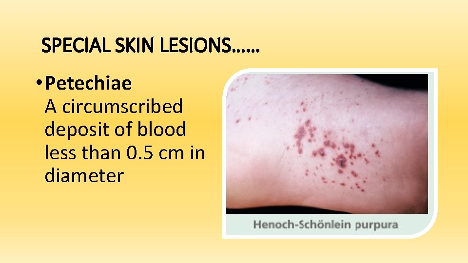 SPECIAL SKIN LESIONS…… • Petechiae A circumscribed deposit of blood less than 0. 5