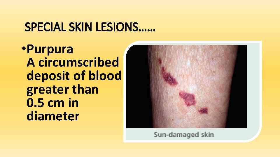 SPECIAL SKIN LESIONS…… • Purpura A circumscribed deposit of blood greater than 0. 5