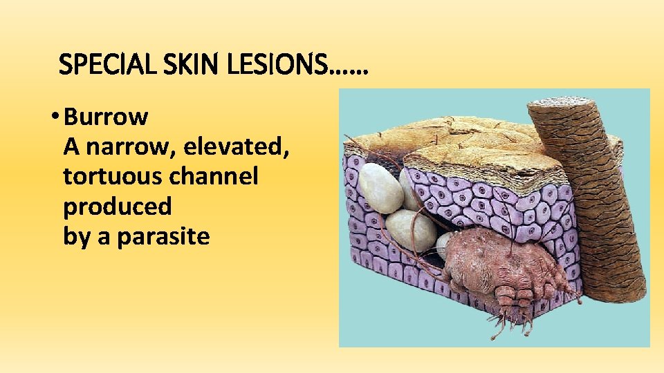SPECIAL SKIN LESIONS…… • Burrow A narrow, elevated, tortuous channel produced by a parasite