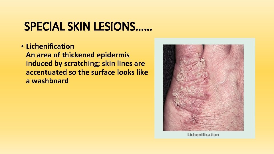 SPECIAL SKIN LESIONS…… • Lichenification An area of thickened epidermis induced by scratching; skin