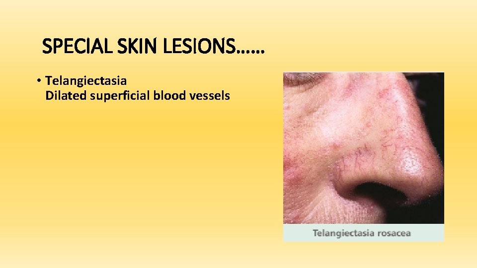 SPECIAL SKIN LESIONS…… • Telangiectasia Dilated superficial blood vessels 