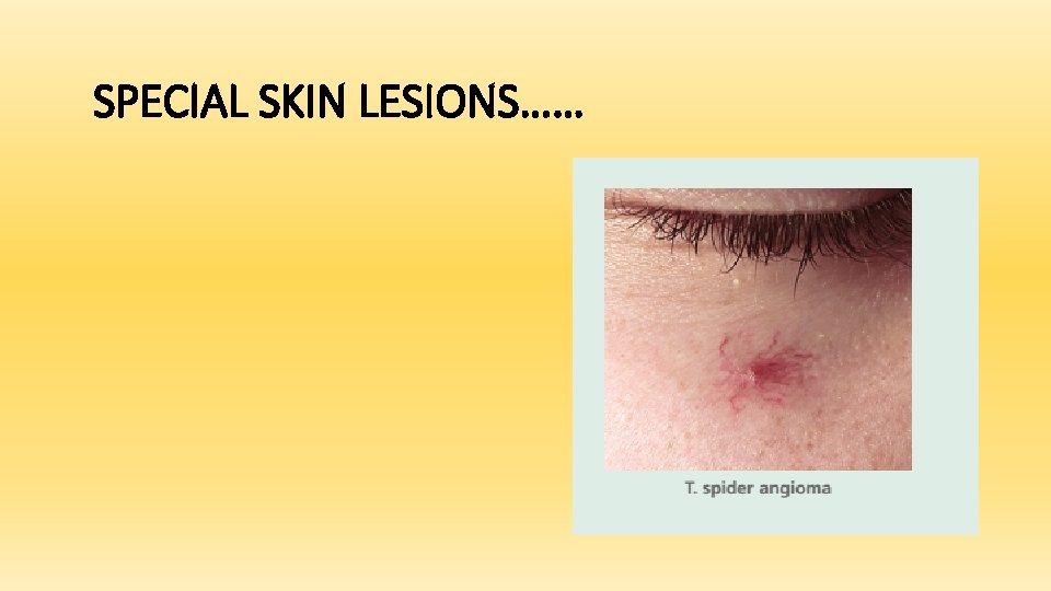SPECIAL SKIN LESIONS…… 
