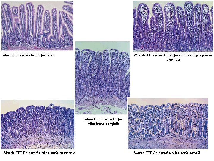 Marsh I: enterită limfocitică Marsh II: enterită limfocitică cu hiperplazie criptică Marsh III A: