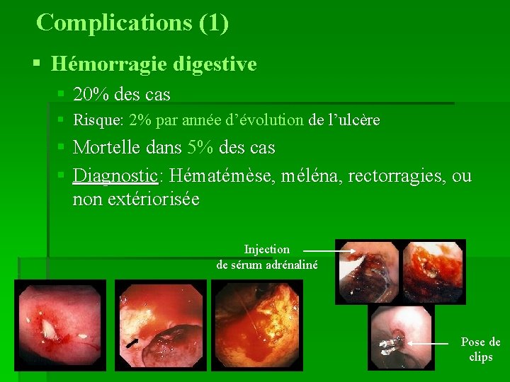 Complications (1) § Hémorragie digestive § 20% des cas § Risque: 2% par année