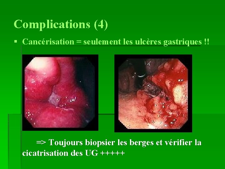 Complications (4) § Cancérisation = seulement les ulcères gastriques !! => Toujours biopsier les