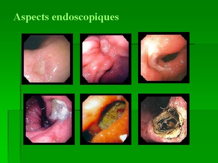 Aspects endoscopiques 