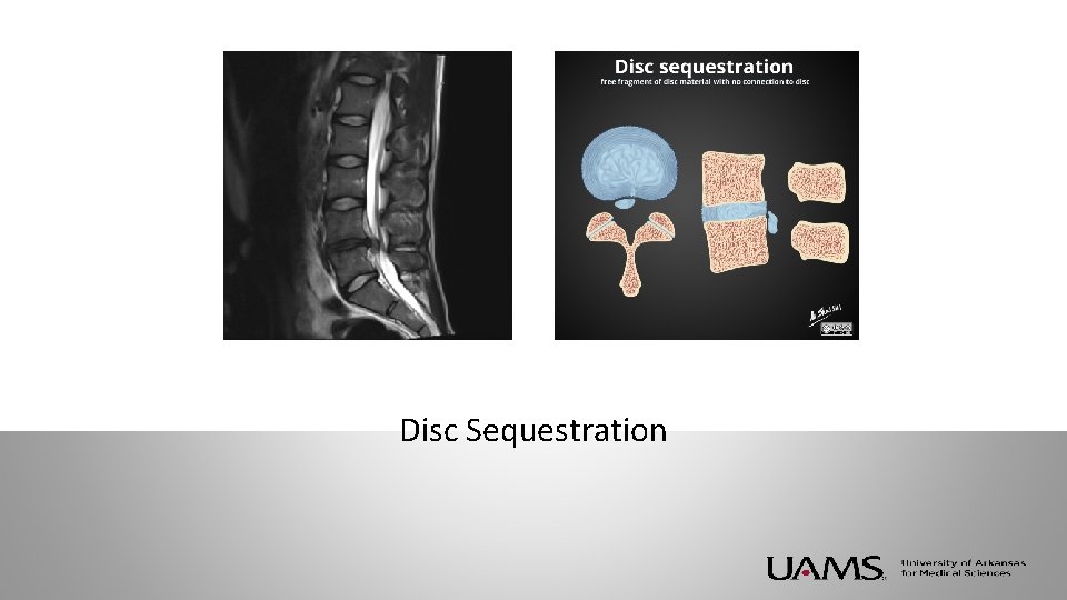 Disc Sequestration 