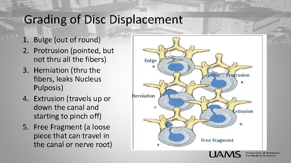 Grading of Disc Displacement 1. Bulge (out of round) 2. Protrusion (pointed, but not