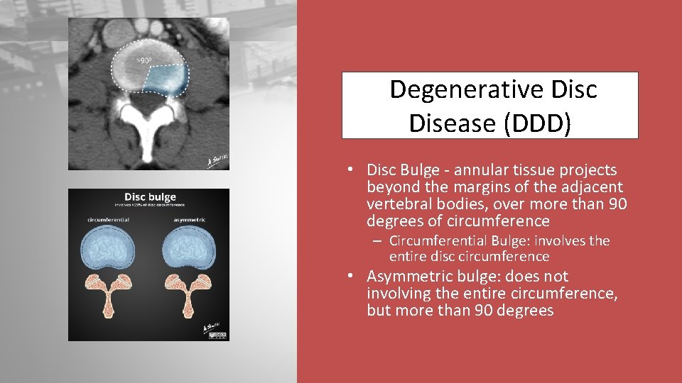 Degenerative Disc Disease (DDD) • Disc Bulge - annular tissue projects beyond the margins