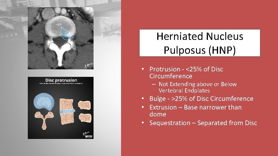 Herniated Nucleus Pulposus (HNP) • Protrusion - <25% of Disc Circumference – Not Extending