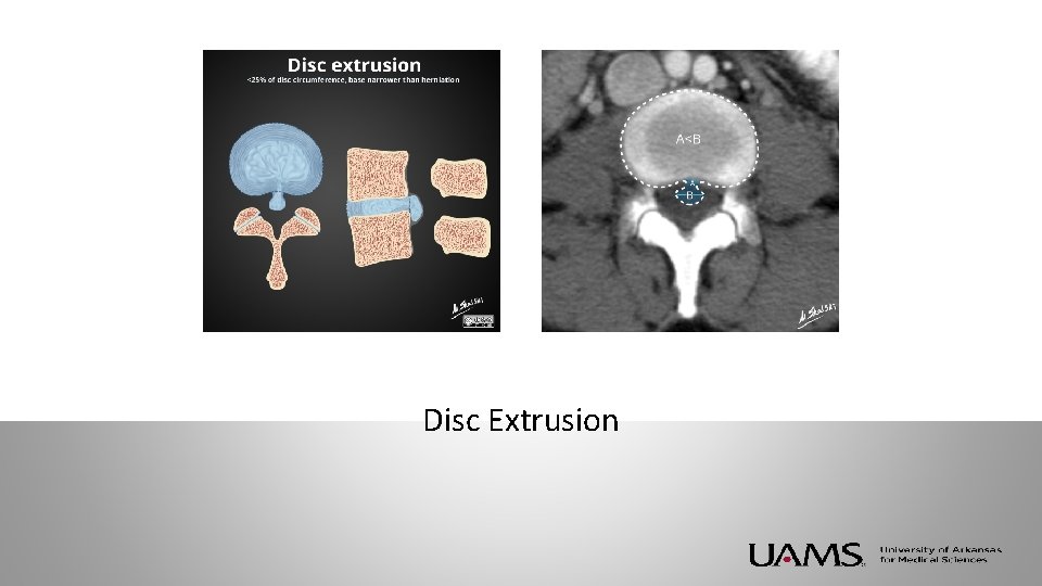 Disc Extrusion 