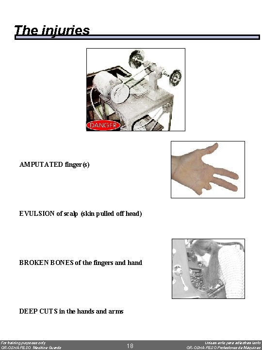 The injuries AMPUTATED finger(s) EVULSION of scalp (skin pulled off head) BROKEN BONES of