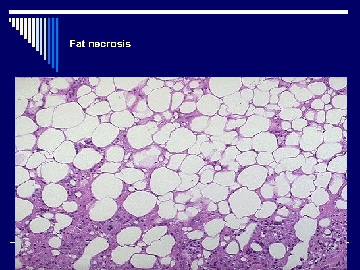 Fat necrosis 