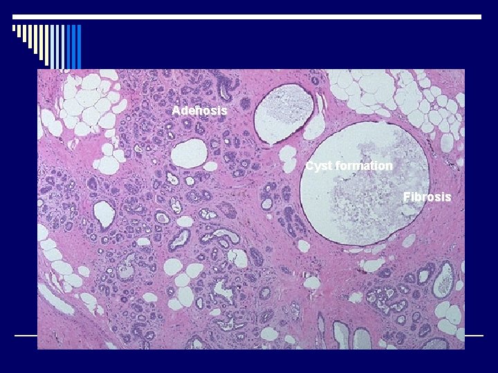 Adenosis Cyst formation Fibrosis 
