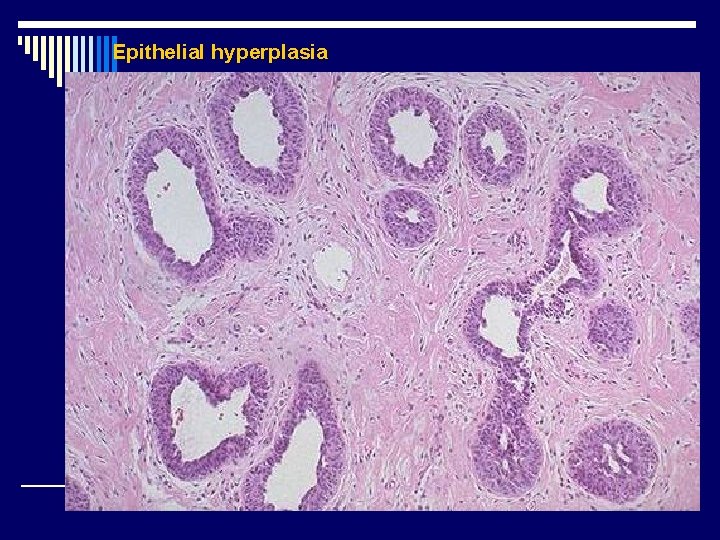 Epithelial hyperplasia 