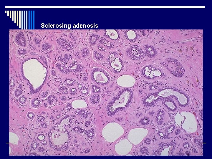 Sclerosing adenosis 