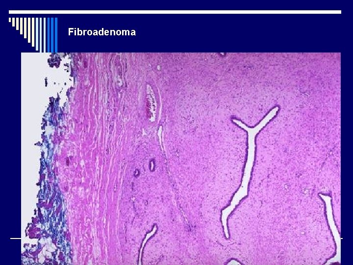 Fibroadenoma 