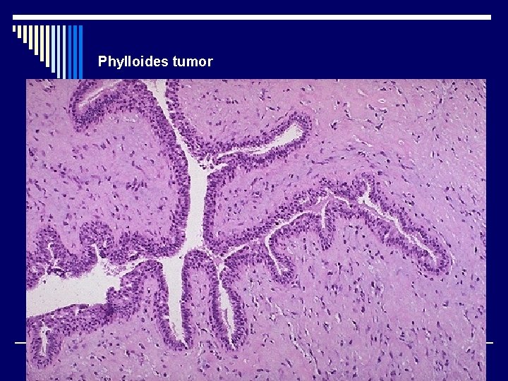 Phylloides tumor 
