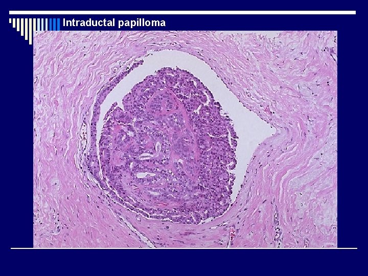 Intraductal papilloma 