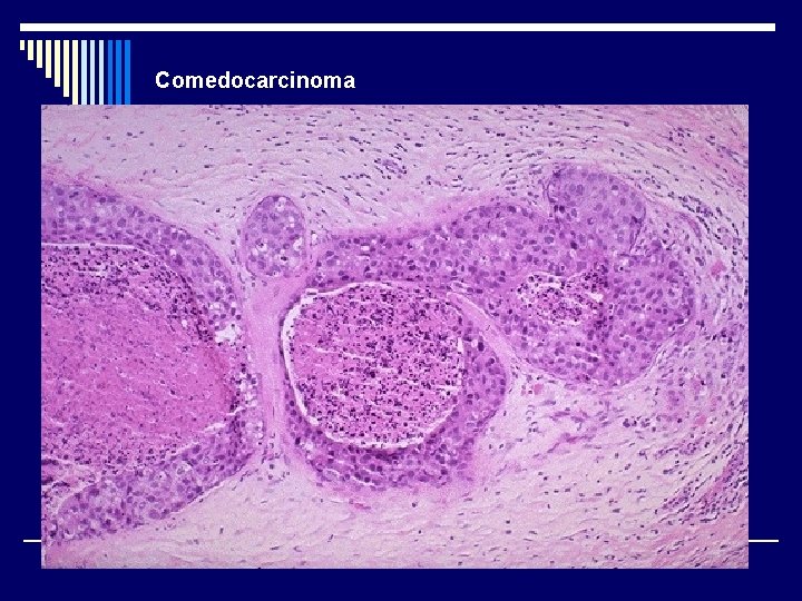 Comedocarcinoma 