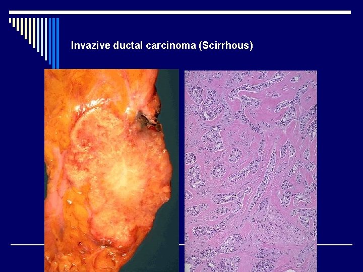 Invazive ductal carcinoma (Scirrhous) 