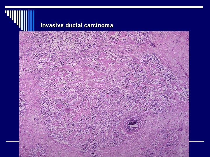 Invasive ductal carcinoma 