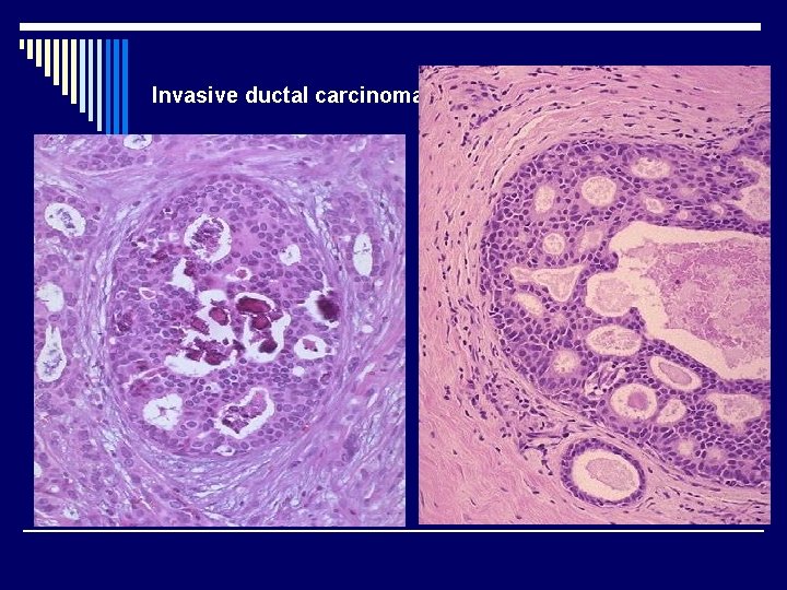 Invasive ductal carcinoma 
