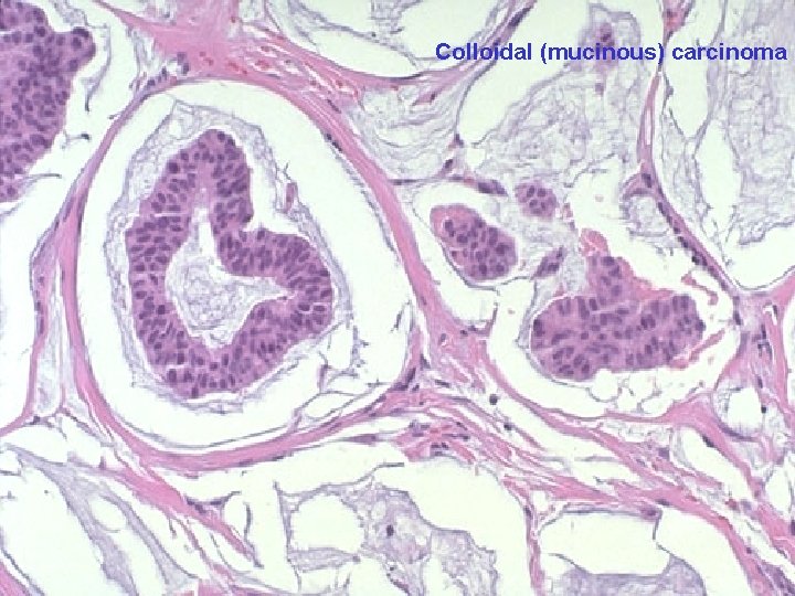 Colloidal (mucinous) carcinoma 