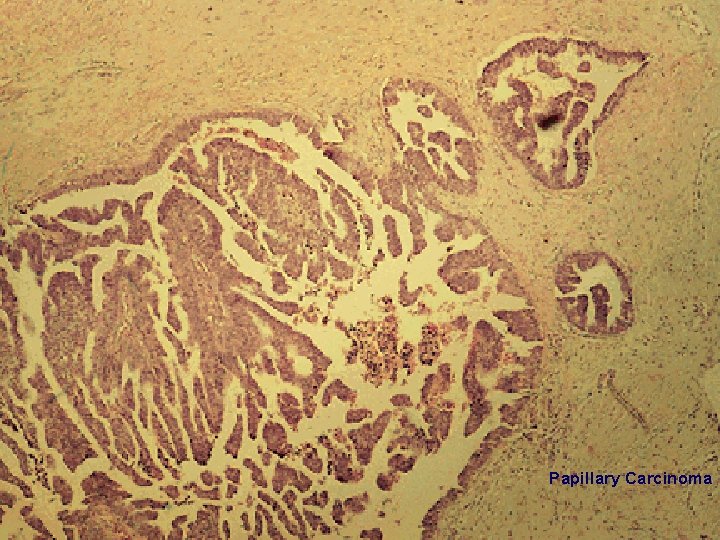 Papillary Carcinoma 