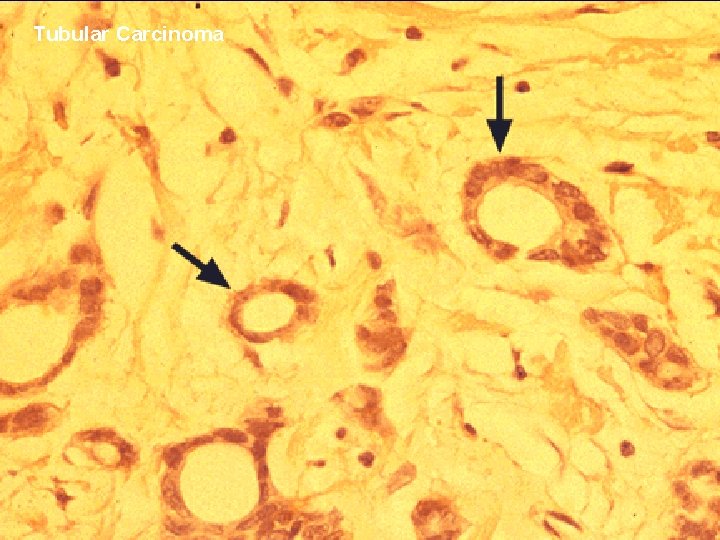 Tubular Carcinoma 